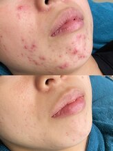 ソリッジ肌管理室/ニキビケア