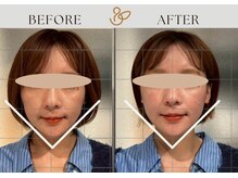 チョコバリ 郡山店(chocobari)の雰囲気(小顔リフト美容鍼 リフトアップ/むくみ/美容鍼/肌ツヤアップ)