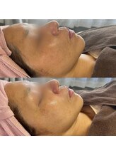 ルチルス(Rutiles)/40代/ワイコ水光ピール/ツヤ感UP