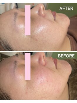 ギルドハナレ(GUILD HANARE)/"プラズマシャワー"