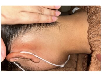 ベルフィオーレ(bel fiore)/10代女性 1ヶ月後 After