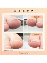 ココネ(cocone)/巻き爪ケア