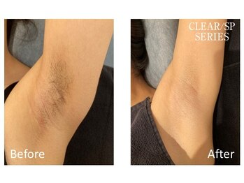シフォン(Chiffon)/脇脱毛　before★after　1