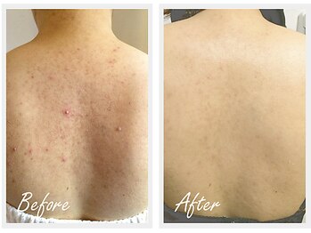 エステティックサロン S/背中のニキビケア、跡ケア