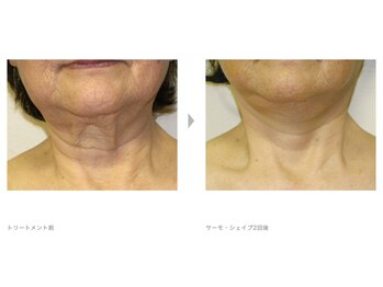 Nビューティー/最新RFサーモシェイプオーパス