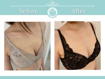 美人バスト 吉祥寺店/バストアップ　★☆症例写真☆★