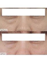 ヴェルシック(Belchic)/目の開きも格段に良くなる