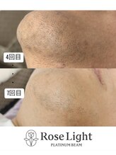 トゥインクル(Twinkle)/通常2,3年かかる髭脱毛が…