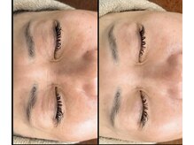 プラズマ+高濃度美容液で目元改善★