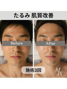 ミピマム 横浜駅前店/たるみ肌質改善 Before After