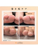 ココネ(cocone)/巻き爪ケア