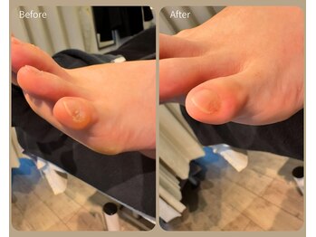 セレネス(SERENESSE)/Before and after