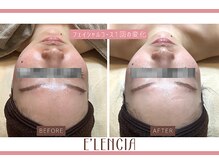 エレンシア(E'lencia)の雰囲気（１回で変化実感！【毛穴・美白・肌質改善】化粧ノリもUP！！）