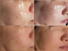 エステティックホドキ(esthetic HODOKI)の雰囲気（シミケア｜濃いもの薄いもの、左右対称のもの・広範囲も集中ケア）