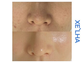 シューラディアント 金沢店(ShuRadiant)の写真/【毛穴洗浄×ピーリング】敏感肌OK◎ララピールorセラピールで理想の美肌へ♪オプションでビタミン導入も♪