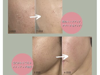 メディカルサロン ティアラ 亀有本店/【ハーブピーリング】