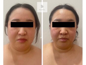 レミュ(Remu)/脂肪燃焼液5ml