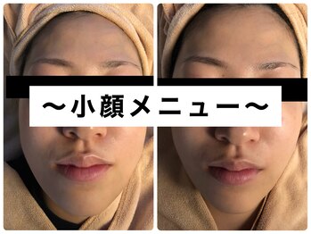 ベルージュ(Belrouge)/ラジオ波でスッキリ小顔