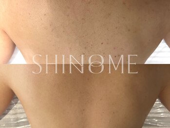 シノノメ(SHINONOME)/*背中ニキビケア