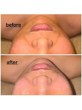 ミニョン(mignon)/ほうれい線、美白