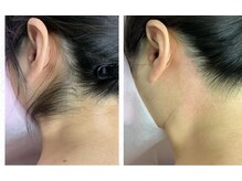 ブリリアンス(BRILLIANCE)/うなじスッキリ！！！