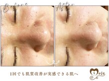 メレ(mele)の雰囲気（毛穴も1回でこんなに♪今まで変化を実感しづらかった方はぜひ！）