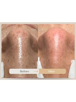 美白ケアをしたい