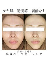 ルボン 宮崎店(RUBON)/ダウンタイムなし、即ツヤ肌