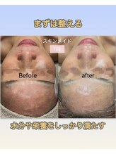 インチャント(enchant)/スキンメイドコース1回