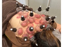 スリー治療院 伏見桃山(THREE治療院)/【鉄板背中から卒業】カッピング