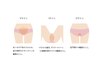 【レディース脱毛】VIOを美肌脱毛！