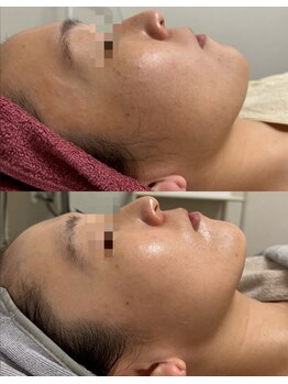 オルオル 天神大名店(Olu-.olu.)/肌質改善しみ改善/小顔/ツヤ肌