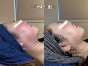 アイシス(AIsis)/【肌質改善/小顔】LDMプラチナ