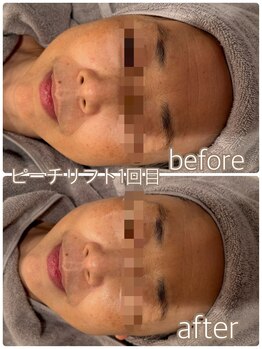 シャンス(Chance)/ピーチリフト 症例1回目