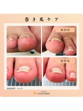 ココネ(cocone)/巻き爪ケア