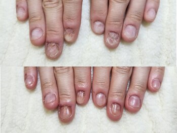 グラシナ なんば店/深爪/自爪育成/フィルイン