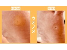 ウォーク イオンスタイル東淀川(WALK)/魚の目／ウオノメ