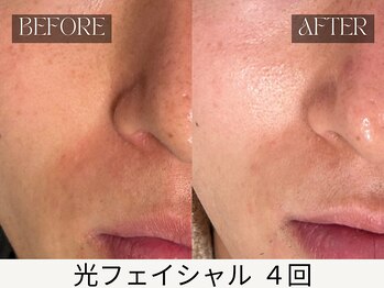 スキンジム(SKIN GYM)/鼻横の赤み・くすみ改善