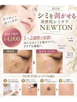 ホアロハ(Hoaloha)の写真/1~2週間で実感！★次世代シミケア「NEWTON」
１箇所４０００円＋アフターバーム購入