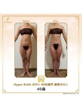 リンカ(Rinka.)/☆帯広初!!ハイパーナイフ導入☆