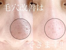 シュリ(Shri)/毛穴撃退コース☆