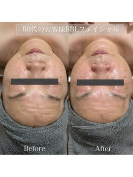 エレーナ(ELENA)/BBLフェイシャル