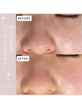 イチ(ichi)/韓国式毛穴洗浄/毛穴ケア