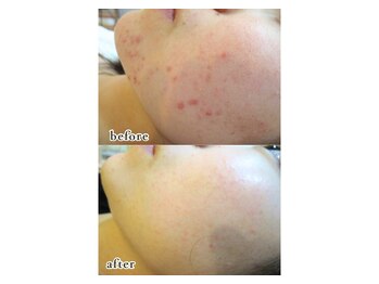 ドクターアリィ(Dr.ALII)/光フォトエステを続けてみたら…