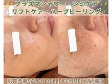 プラズマ×シミケア大人気メニュー☆☆☆