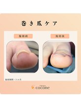 ココネ(cocone)/巻き爪ケア