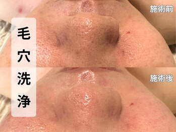 アルピナ(ALPINA)/毛穴洗浄