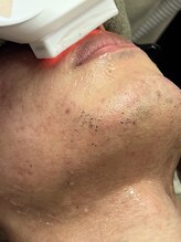 ヴィーナス(Venus)/髭脱毛は初回3900円