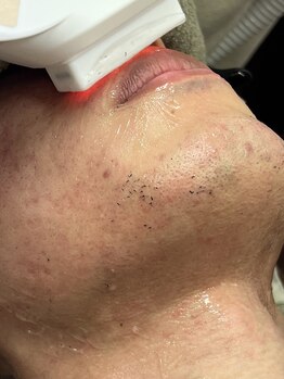 ヴィーナス(Venus)/髭脱毛は初回3900円