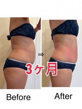 ビーアンベリィ(bee embellie)/ぽっこりお腹解消！！！